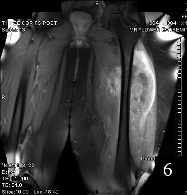 Tumor Surgery : Bone Cancer Tumors : Sarcoma Surgeon : NYC